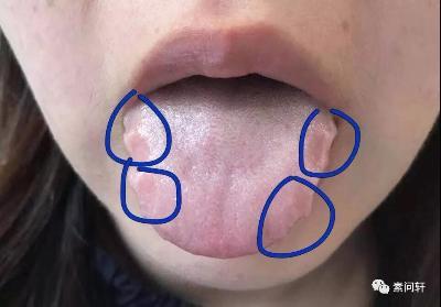 右边侧面长痘痘