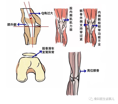 腱鞘积液是怎么回事