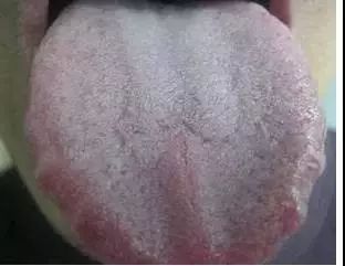 舌苔厚白是怎么回事