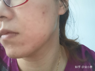 长痘痘后留下的红印