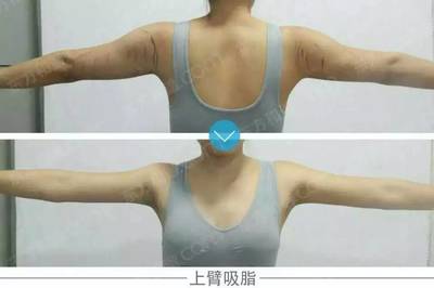 上臂吸脂减肥的价格