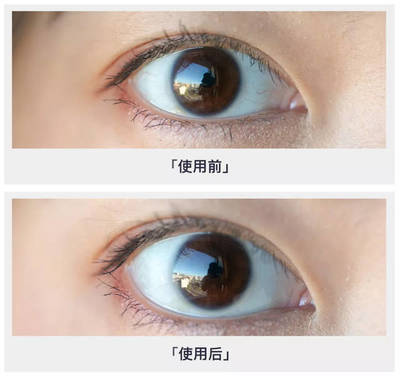 新生儿眼白有血丝是怎么回事