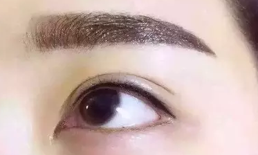 怀孕了能做双眼皮吗