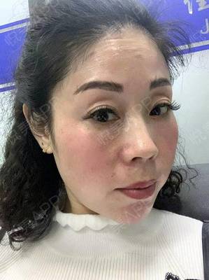 打完婴儿针起痘痘