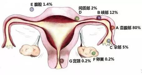 输卵管通而不畅会怀孕吗