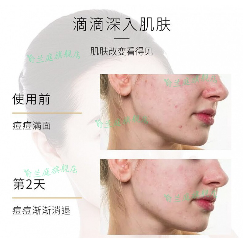 痘痘男護膚哪個好