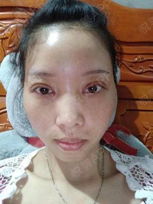 双眼皮术后多久可以洗脸
