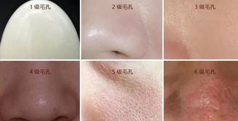 面部毛孔粗大用什么护肤品
