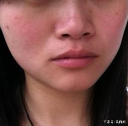 脸颊泛红是怎么回事
