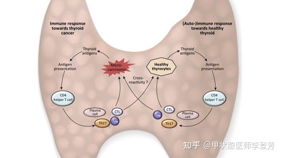 桥本氏甲状腺炎可以怀孕吗