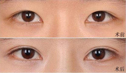 全切双眼皮拆线后