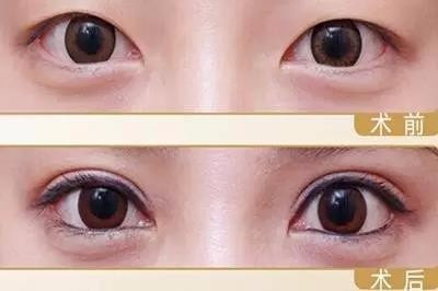 割双眼皮眼型