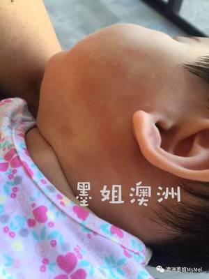 荨麻疹可以喝奶粉吗
