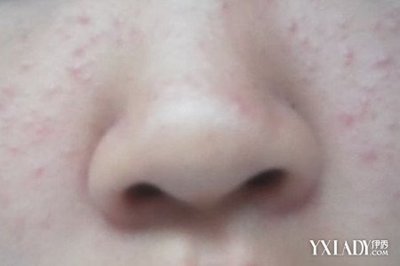 痘痘长满脸
