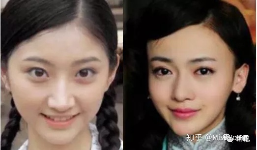割了双眼皮后特后悔