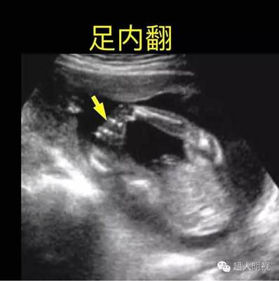 宝宝脚掌内翻