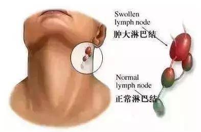 淋巴部位长痘痘怎么治
