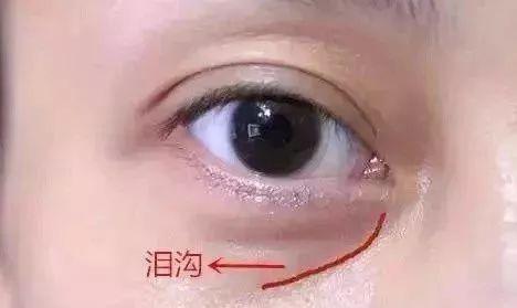 眼部脂肪填充