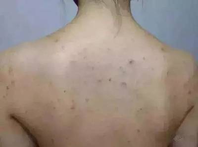 前胸长黑色的痘痘