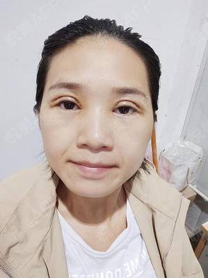 全切双眼皮多久能上班