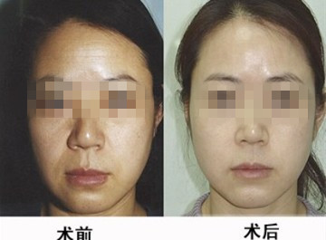 注射祛皱知道广州华美