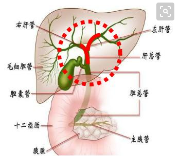 肝管结石怎么治疗最好的方法