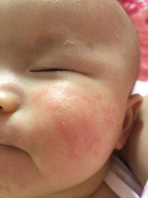 6个月宝宝出疹子症状