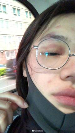 眼睛周围出现红色斑点是怎么回事