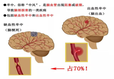 脑卒中怎么治疗