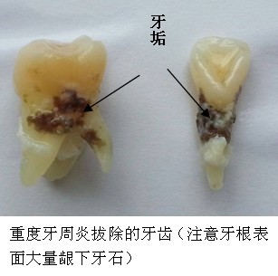 江阴洗牙多少钱