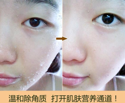 痘痘长完以后皮肤不规整