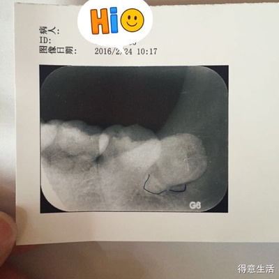 喉咙半边痛是怎么回事
