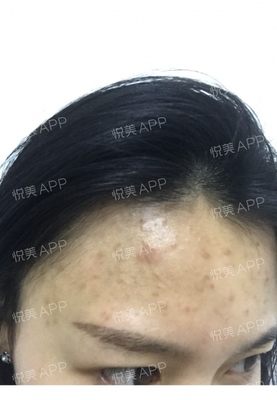 挑痘痘后能洗脸吗