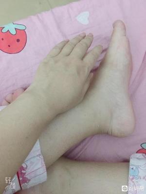 孕妇手肿是什么原因