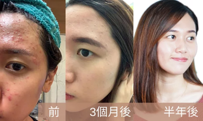 去美容院针清痘痘好吗