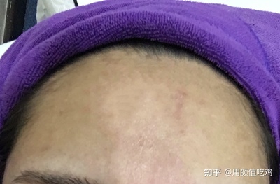 痘痘好了颜值确实提升不少