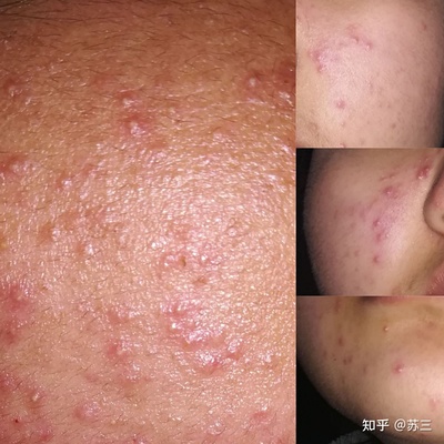 红肿的脓胞痘痘怎么治疗