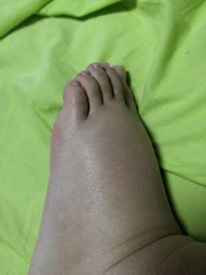 孕妇手肿是什么原因