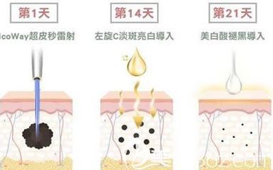 皮秒祛斑多久做一次