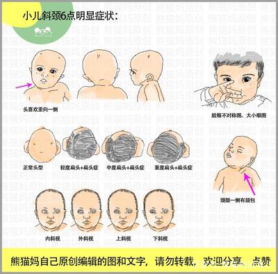 新生儿斜颈