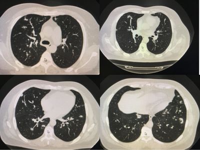 双肺小结节怎么治疗