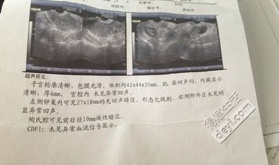 查白带可以查出怀孕吗