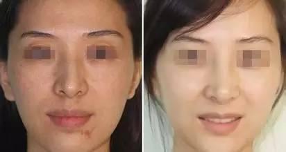 哪个打美白针好