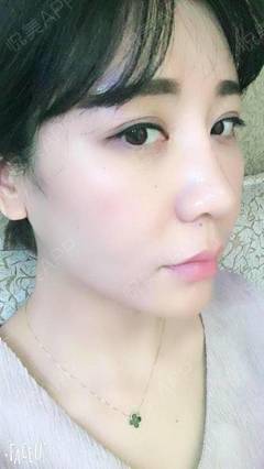 减肥瘦鼻子吗