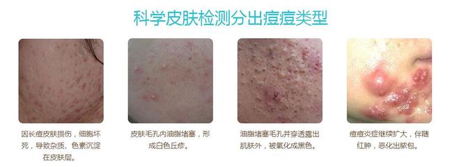 上海治痘痘8号
