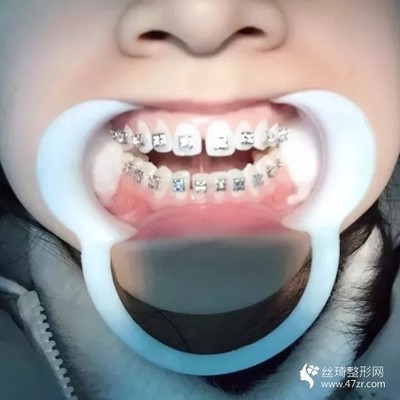 牙齿紧绷是怎么回事