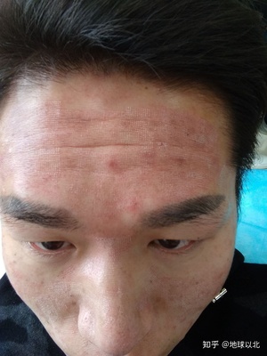 脸部麻木是怎么回事
