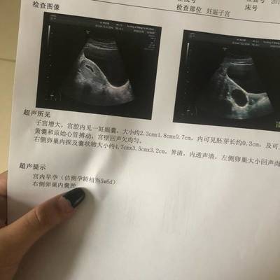刚怀孕流血