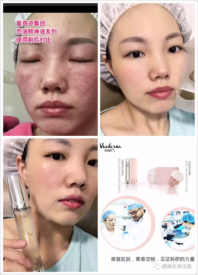 痘痘肌用后的哪个系列