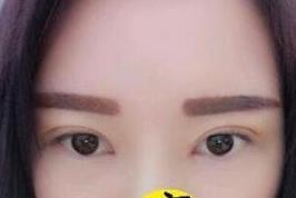 双眼皮太肿